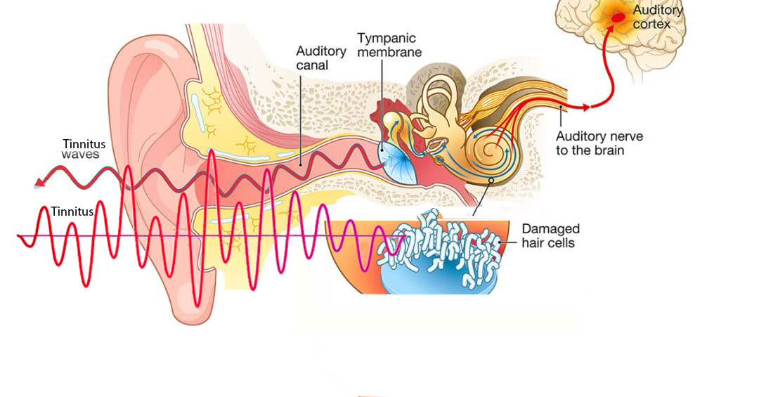 basic tinnitus, tinnitusweb, tinitus dasar teori